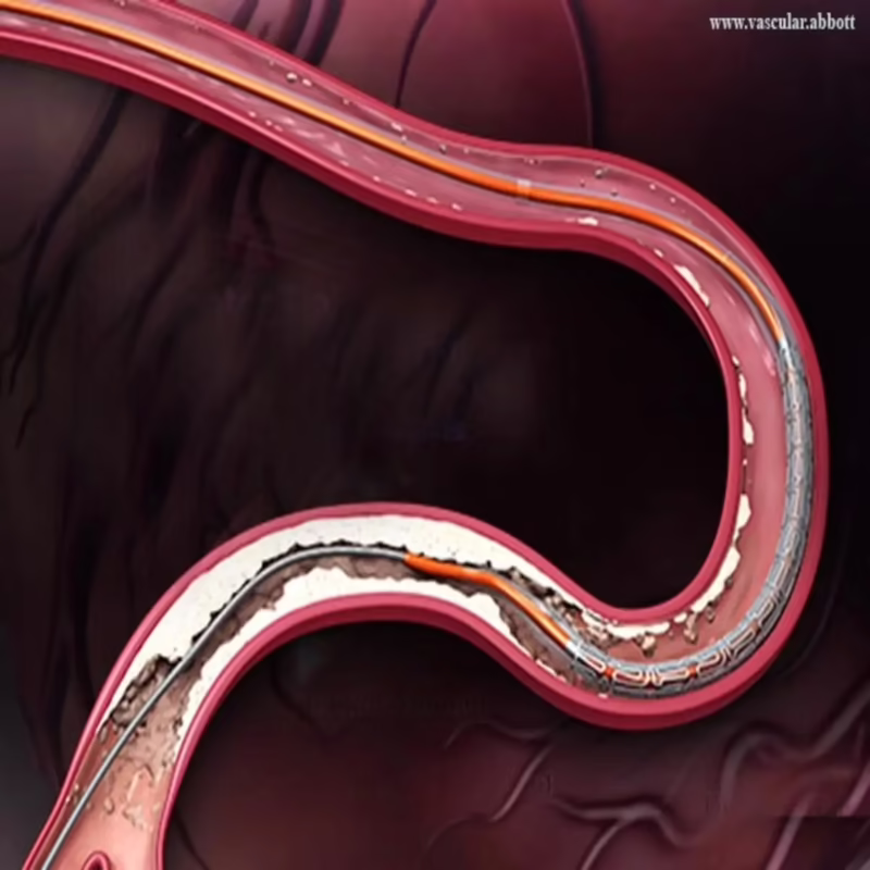 Is a Xience stent good?